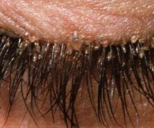 cils 300x250 - Extension de cils, attention aux poux !