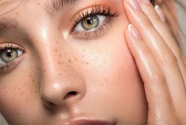 freckles vf  - Comment les tâches de rousseur sont devenues tendance