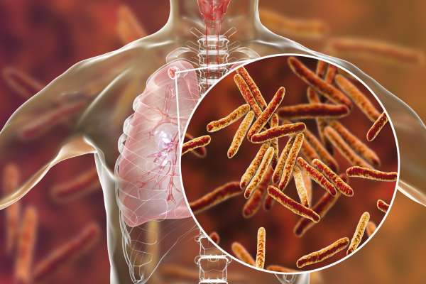 schema poumons tuberculose - La tuberculose au Maroc : Près de 35 000 cas identifiés